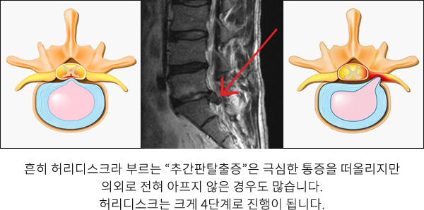 허리디스크