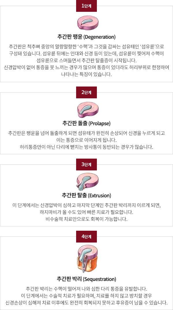 허리디스크의 4단계