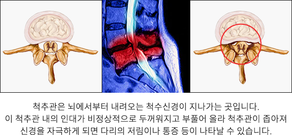 척추관협착증