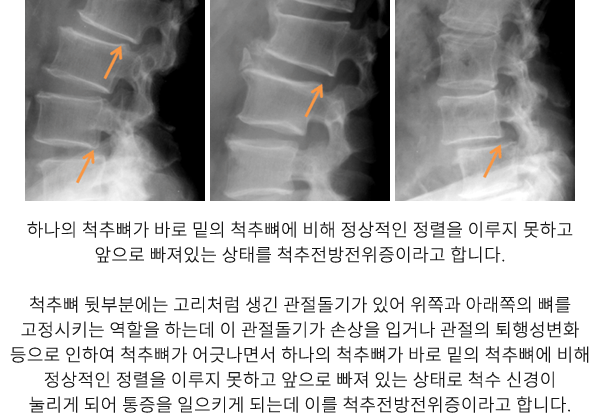 척추전방전위증