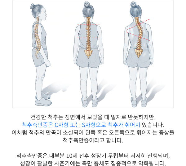 척추측만증