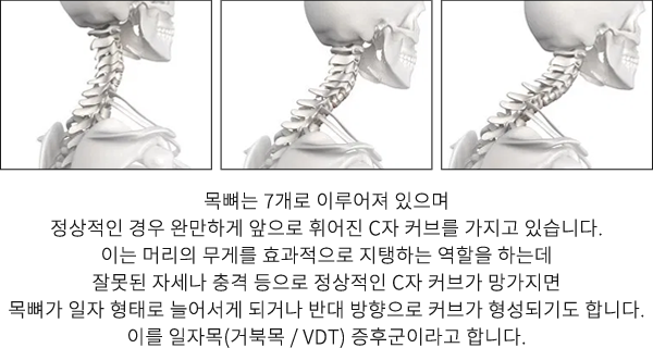 일자목·거북목