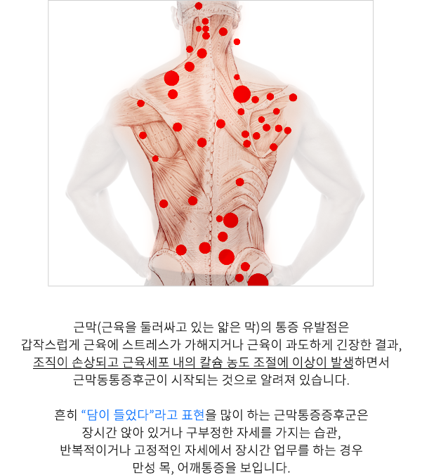 근막통증증후군