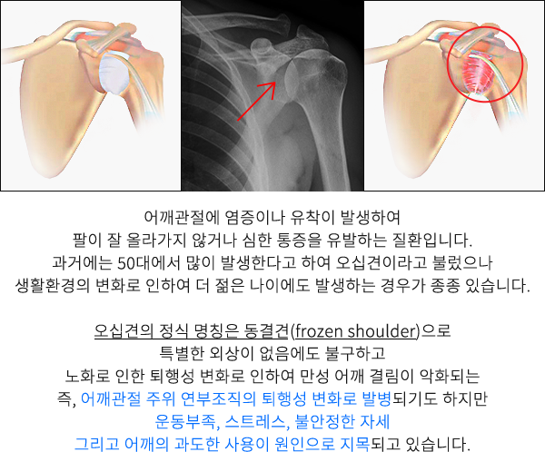 오십견
