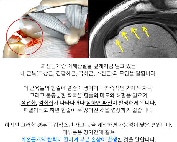 회전근개파열
