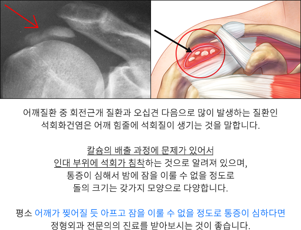 석회성건염
