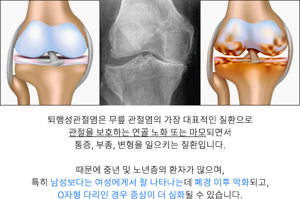 퇴행성관절염