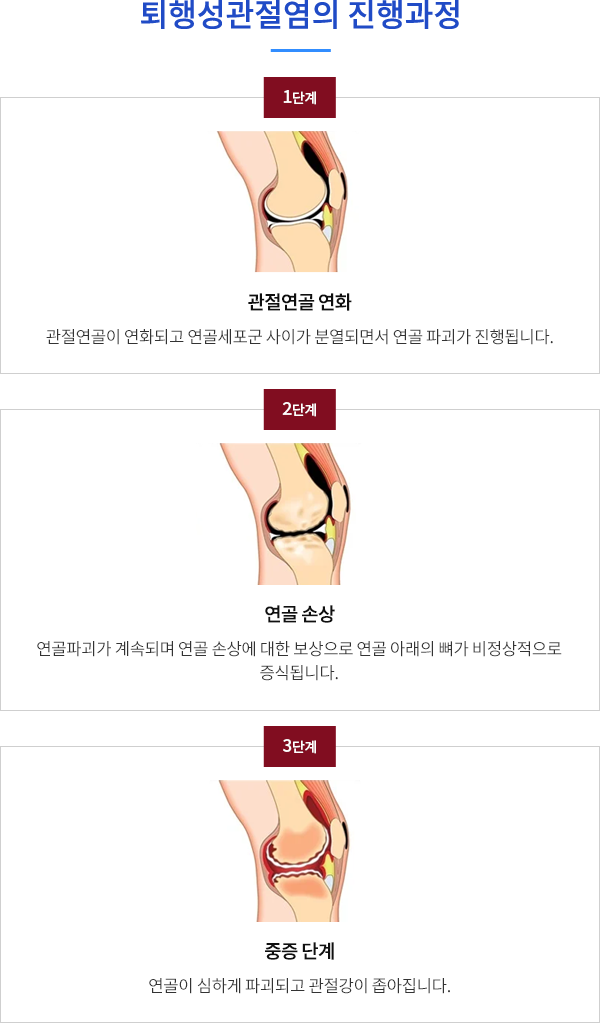 퇴행성관절염의 진행과정