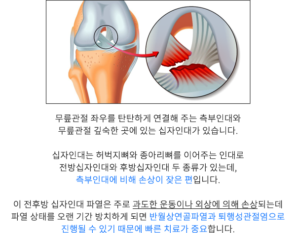 십자인대파열