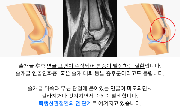 슬개골 연골연화증
