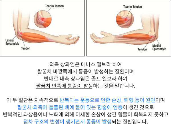 외측&내측상과염