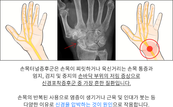 손목터널증후군