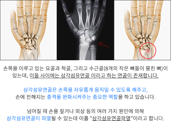 삼각섬유복합체 파열