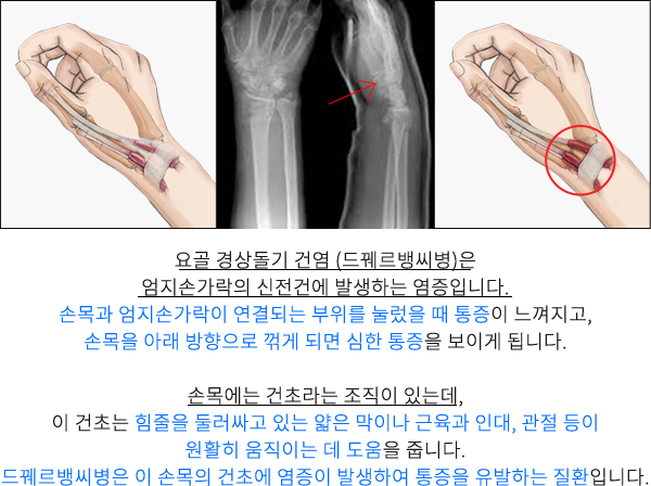 요골 경상돌기 건염