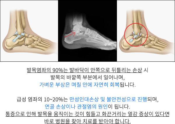 발목염좌 