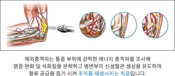 체외충격파