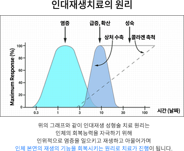 인대재생치료의 원리
